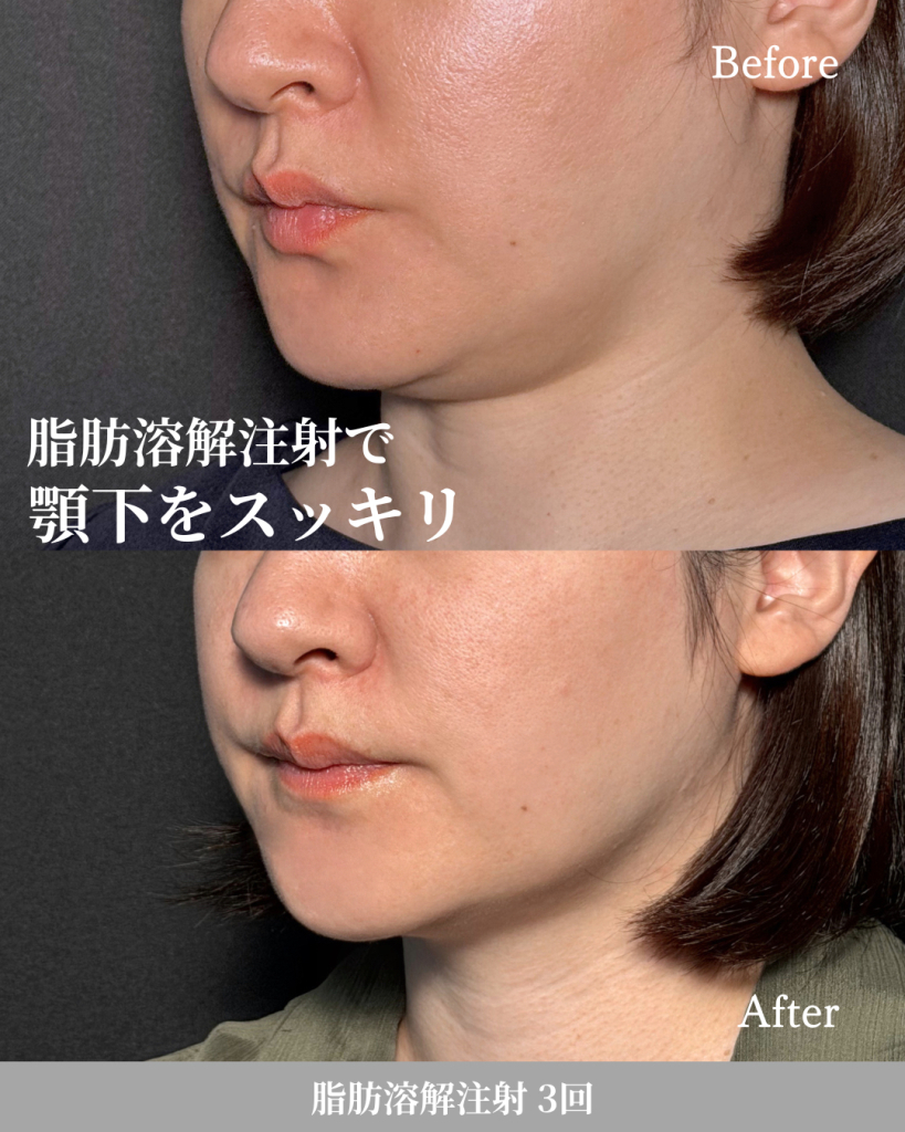 脂肪溶解注射 3回