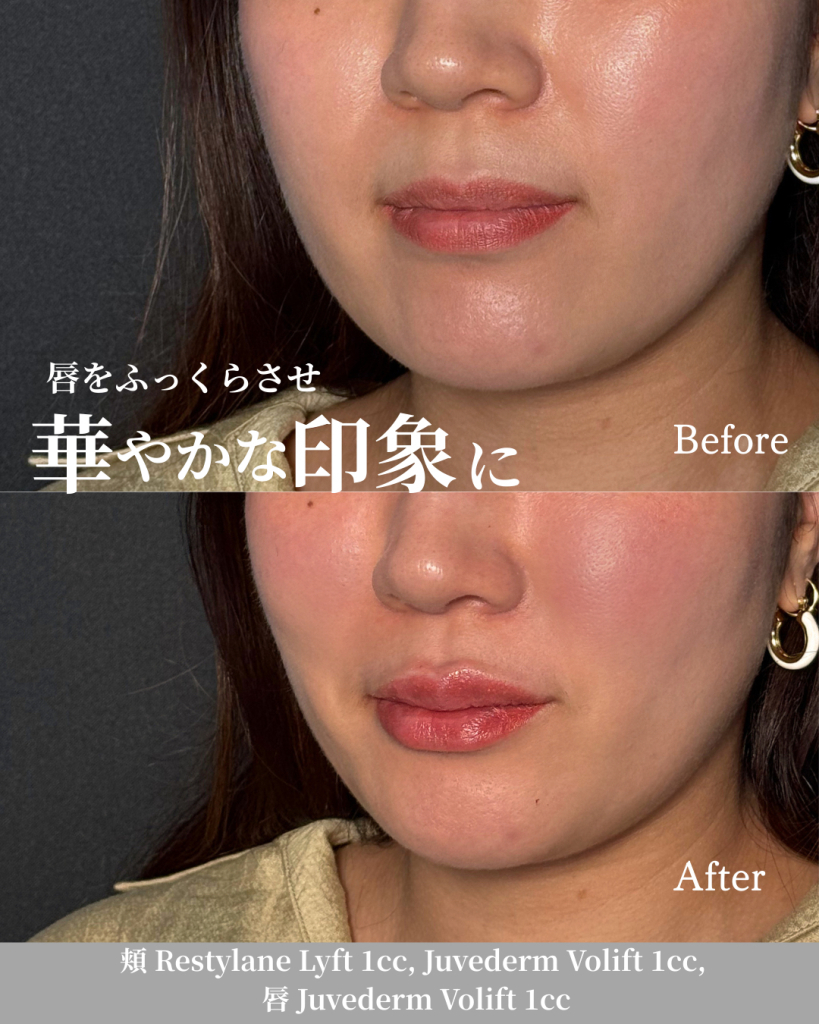 ヒアルロン酸注射(頬 2cc, 唇 1cc)