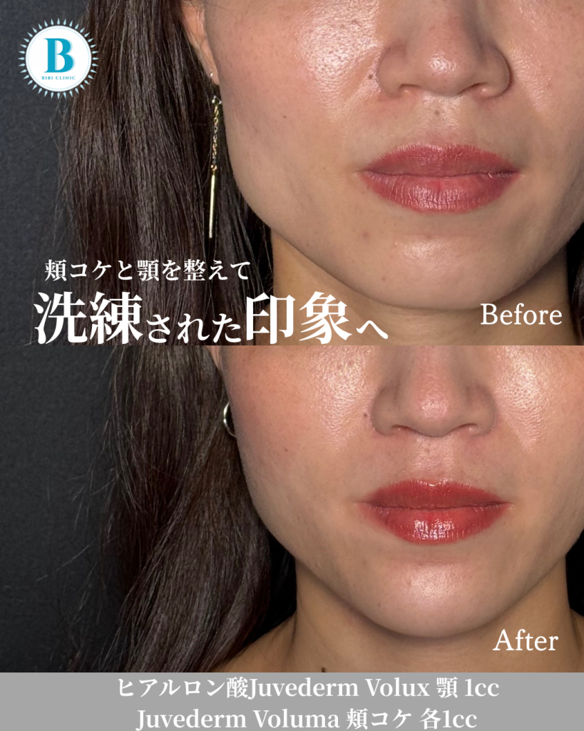 Hyaluronic acid injection (chin 1cc, cheek moss 1cc each)