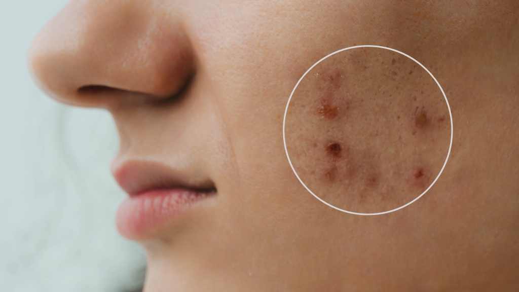 バンコクでクレーター状のニキビ跡にアプローチ！美容施術から正しいセルフケアまで徹底解説【Bibi Clinic監修】