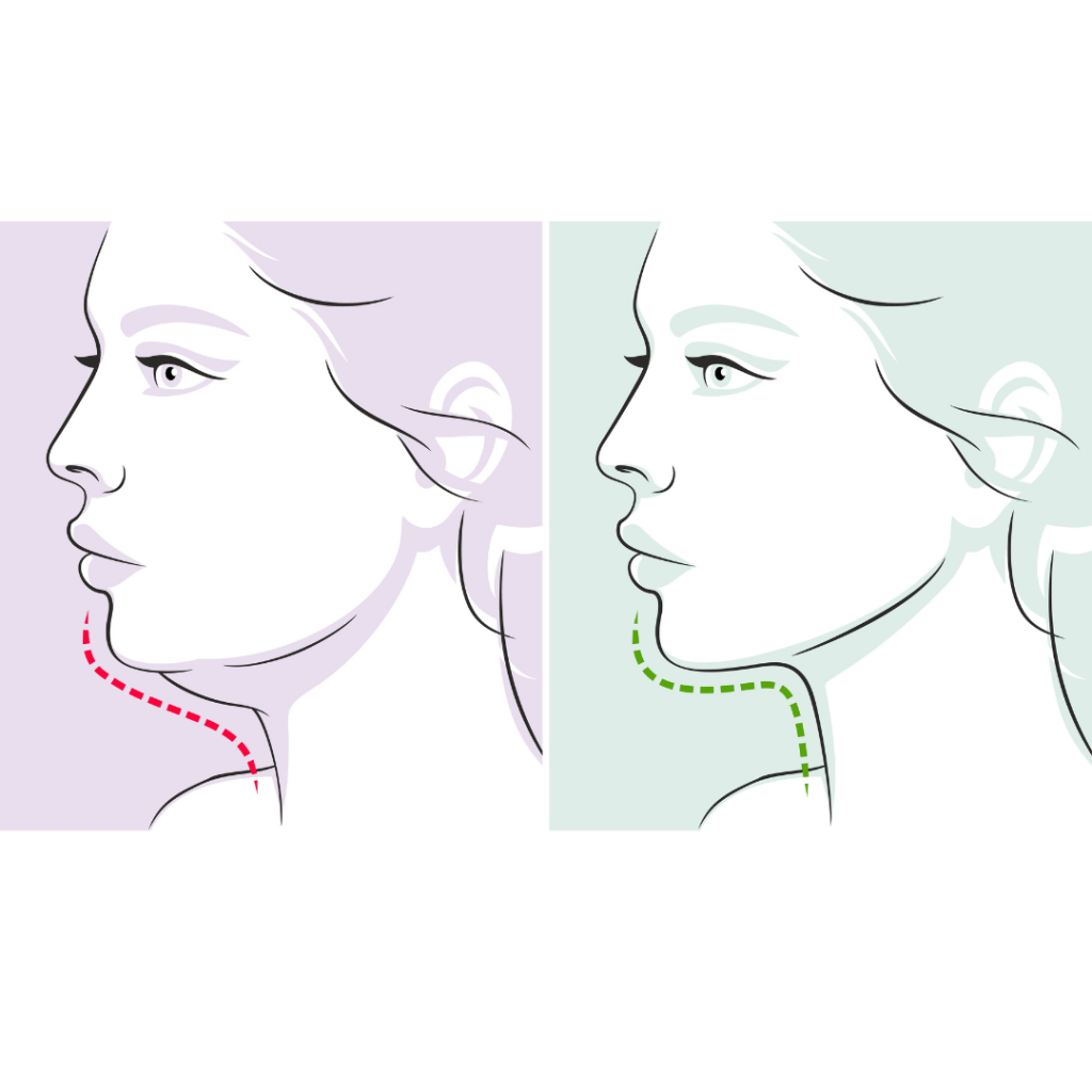 脂肪の減少や下垂