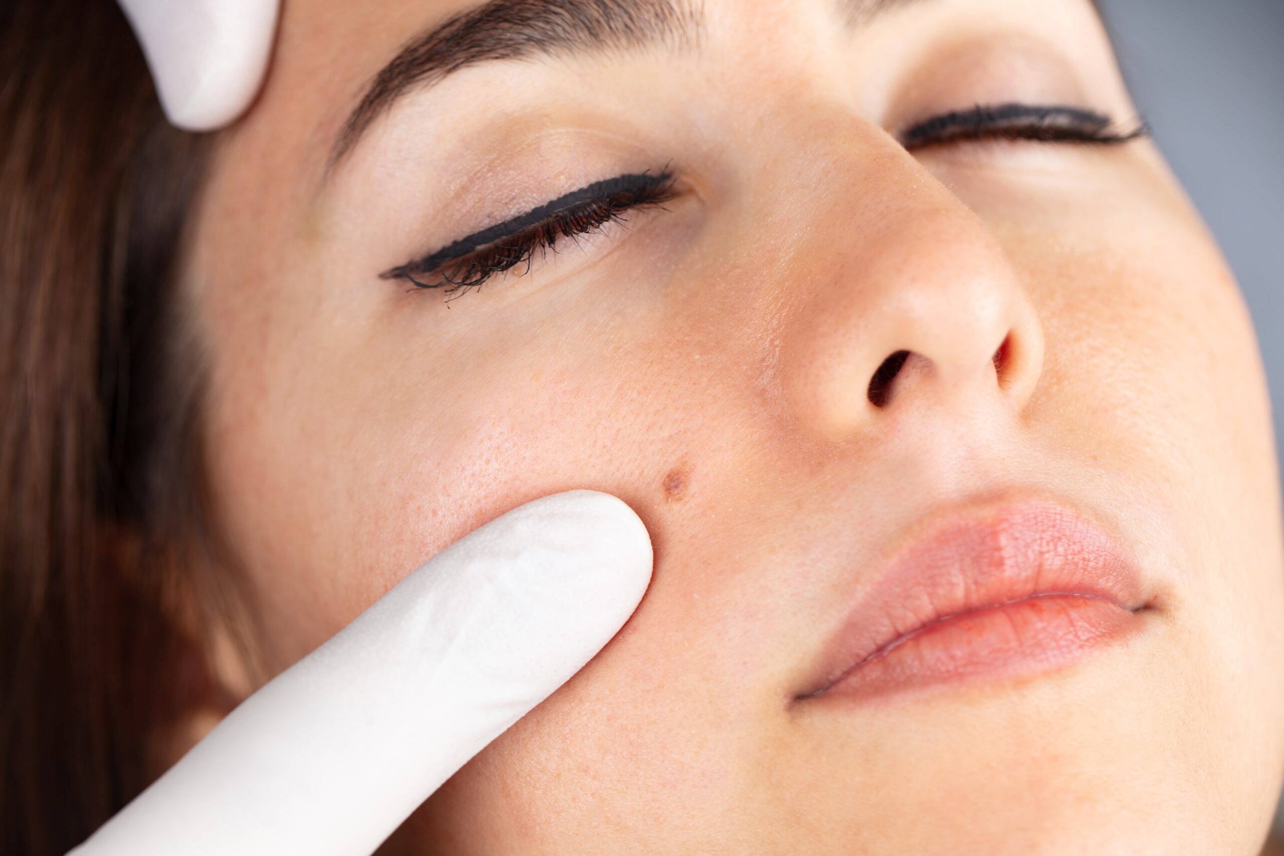 Is it true that spots darken after laser spot removal? How to determine failure and normal progress is explained.