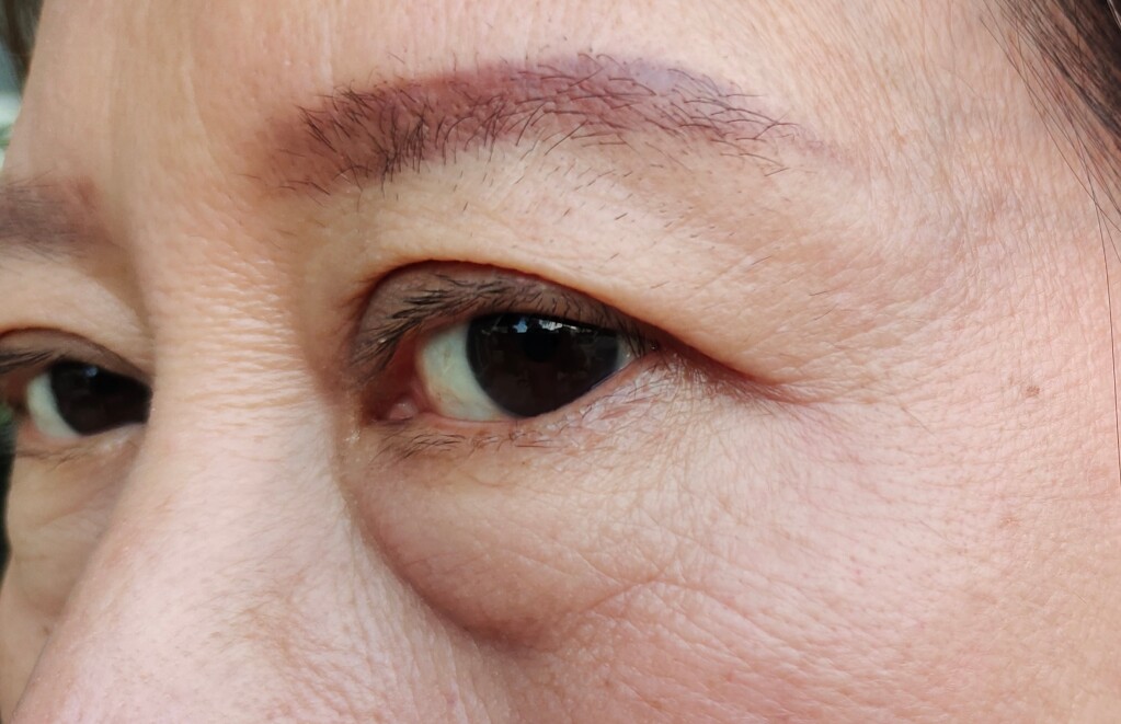 脂肪によるふくらみ