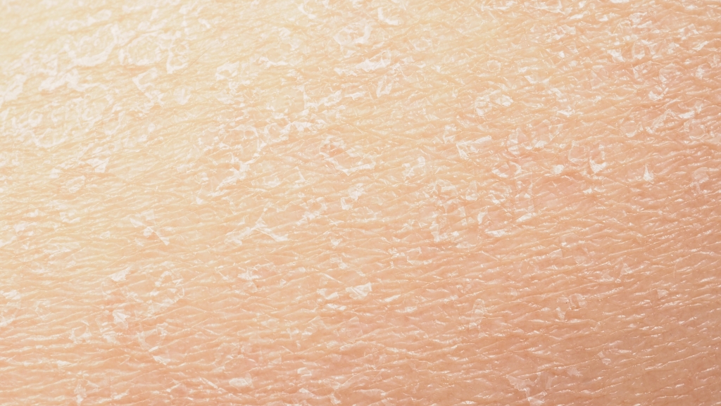 かさつき・粉吹き