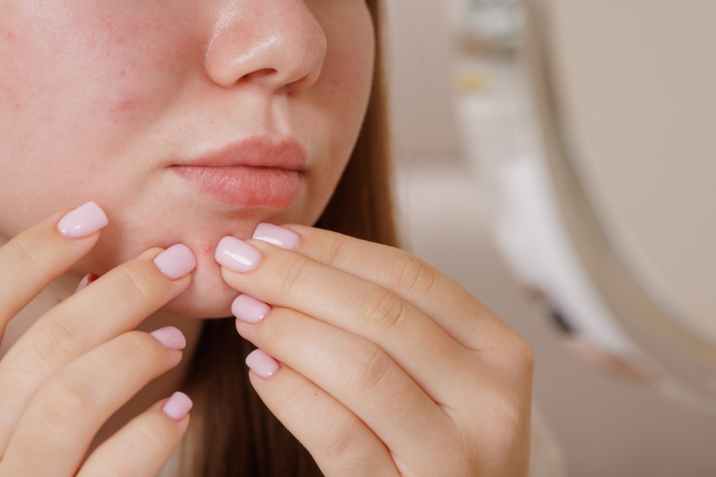 Post-inflammatory hyperpigmentation is caused by inflammation