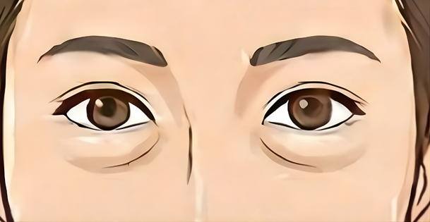 脂肪突出タイプ