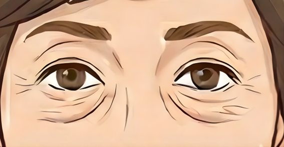 皮膚たるみタイプ