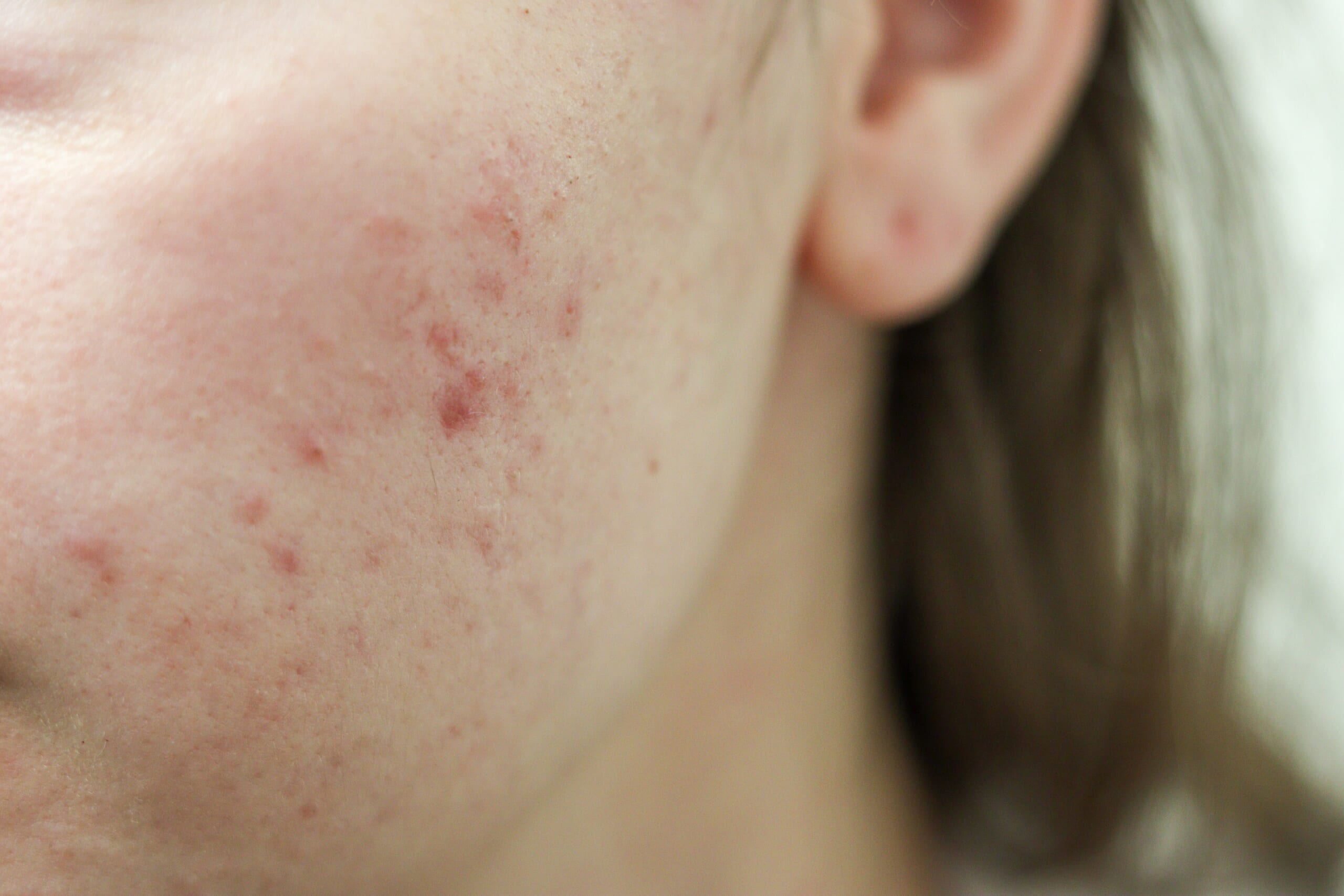 ニキビ跡の色素沈着はなぜ残る?原因とタイ・バンコクでの治療方法を解説|Bibi Clinic|ビビクリニック|タイ・バンコクの美容クリニック