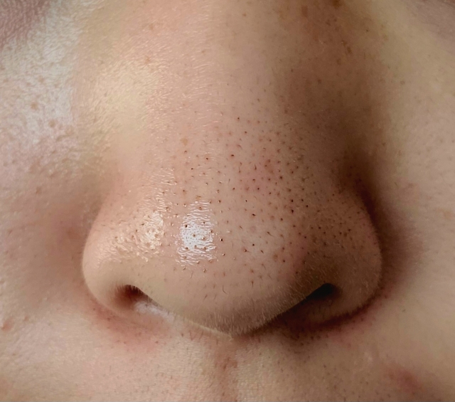 Sebum oxidation types