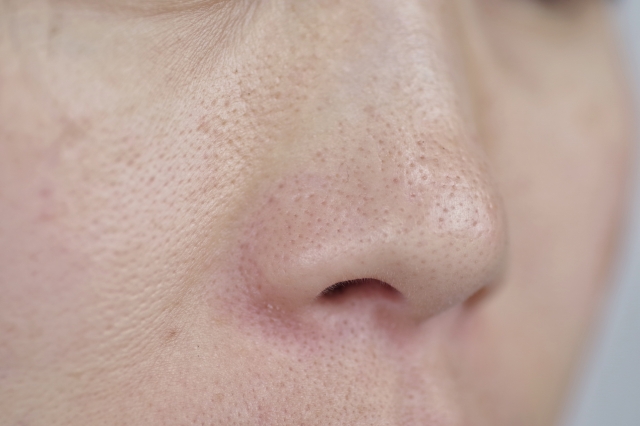 Pore ​​blackheads