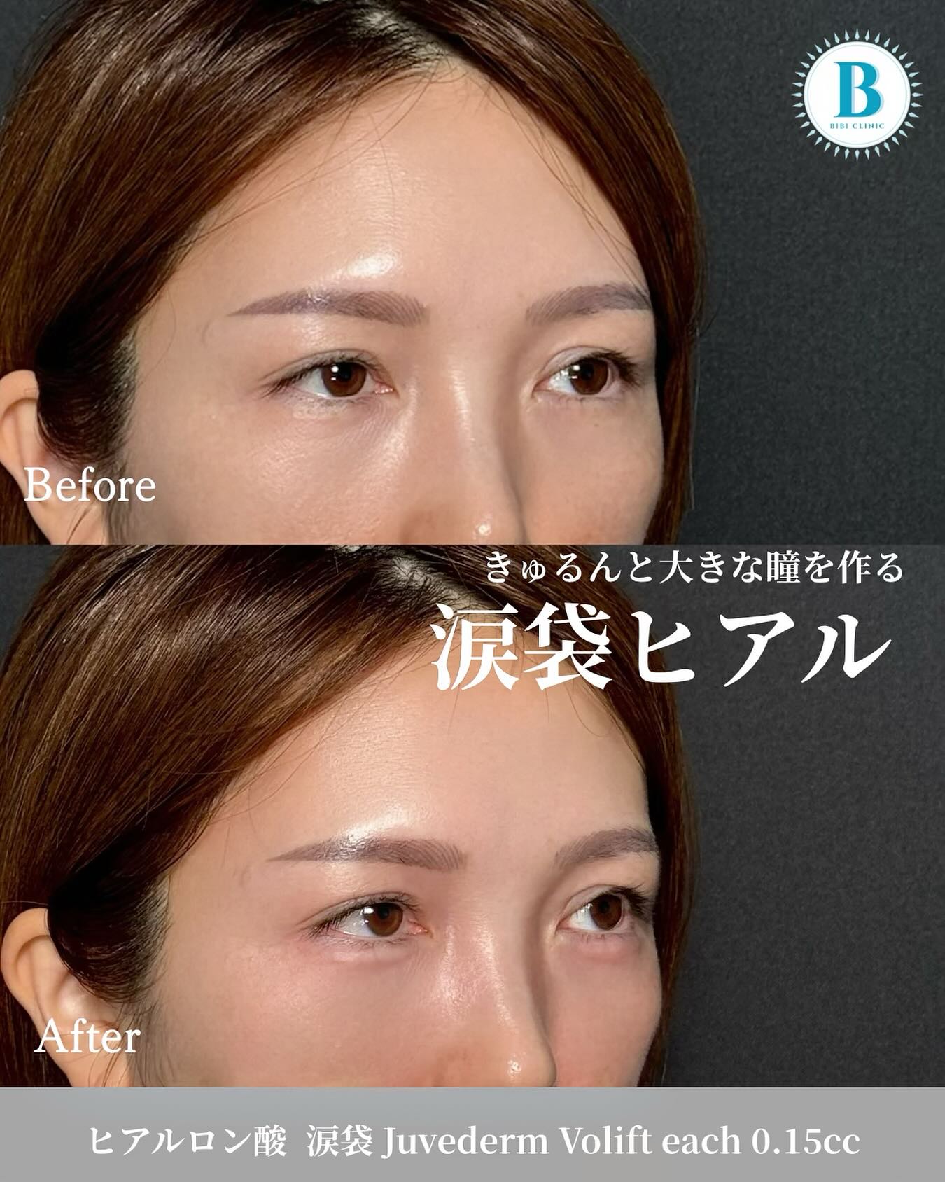 Before-and-after results from treatment at Bibi Clinic