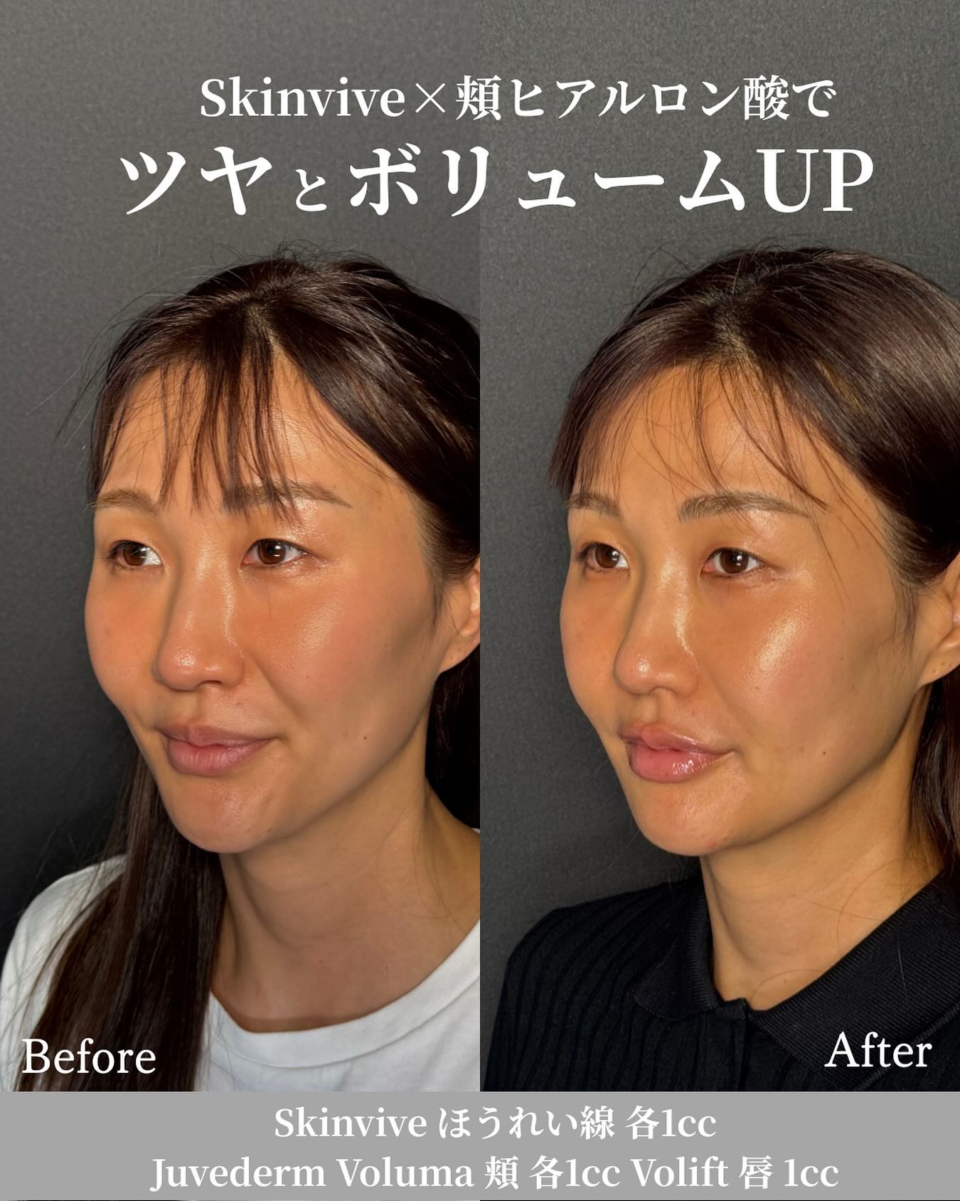 Before-and-after results from treatment at Bibi Clinic