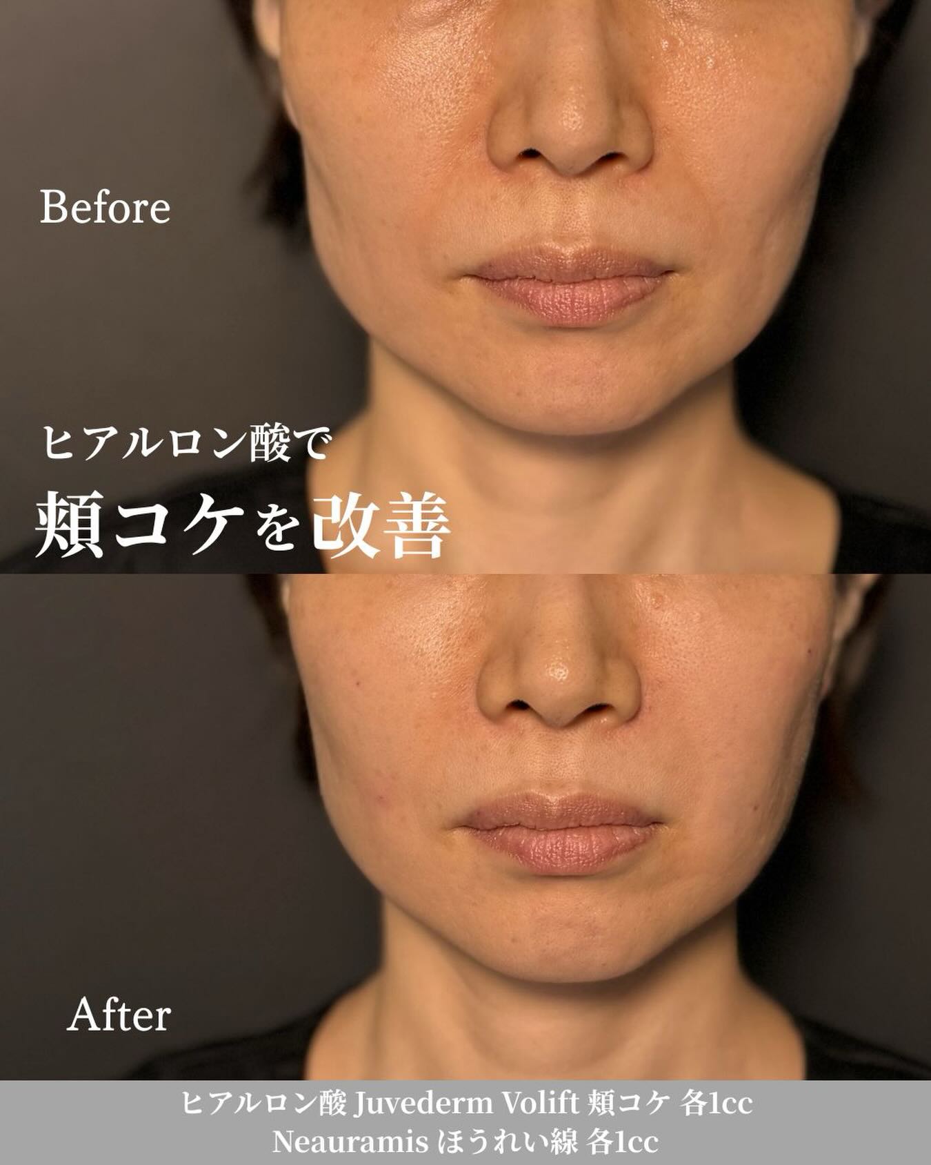 Before-and-after results from treatment at Bibi Clinic