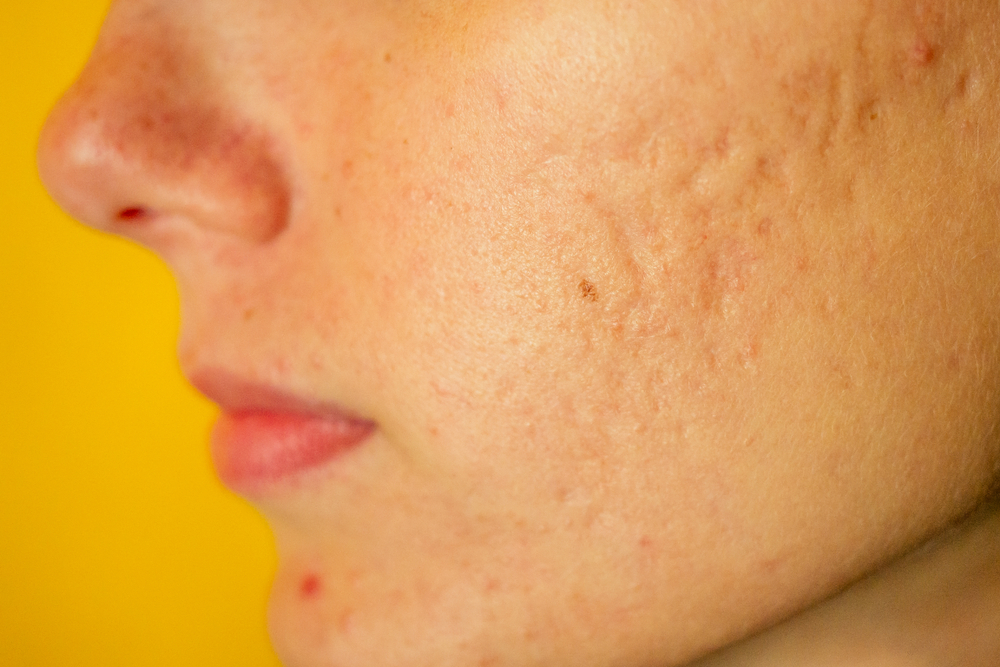 Skin texture