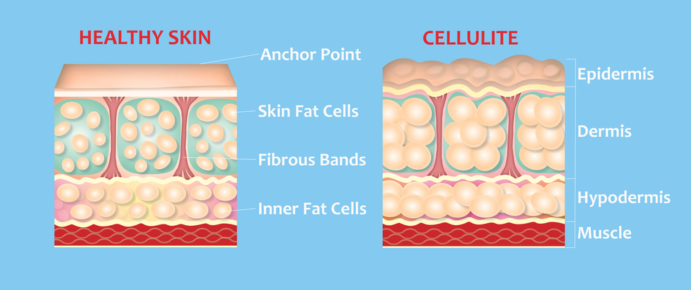 "Cellulite-like lumps" caused by poor blood circulation and uneven fat distribution