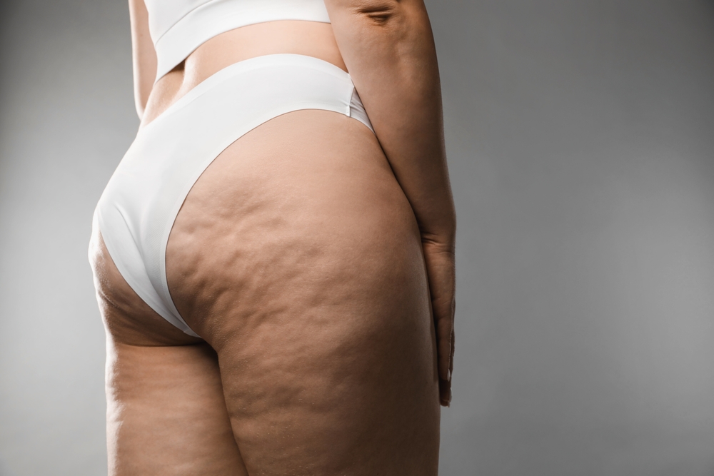Cellulite