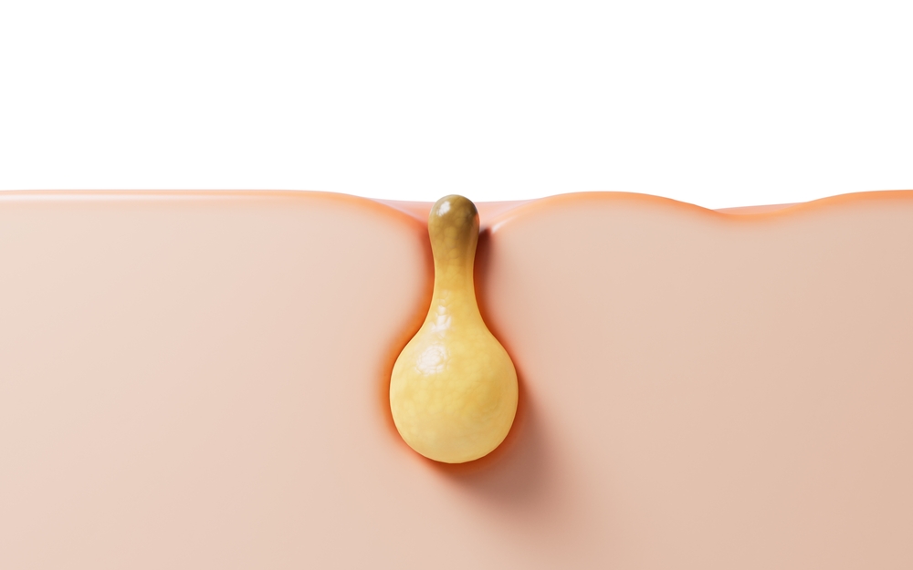 Thickening and hardening of the stratum corneum due to self-care methods