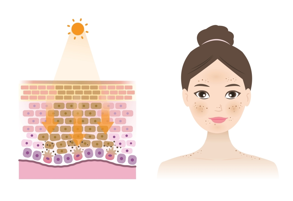 The accumulation of irritation leads to hyperpigmentation.