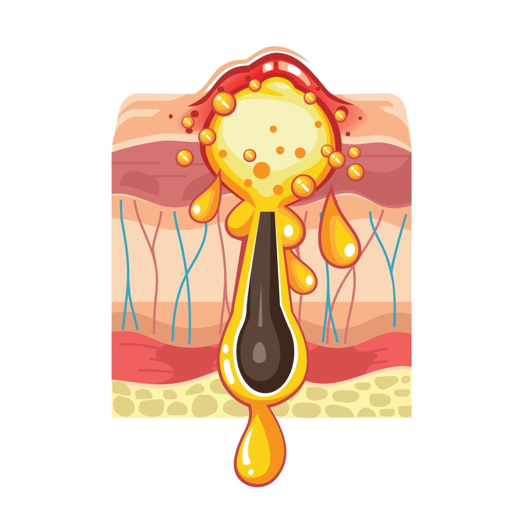 Collagen damage due to severe inflammation