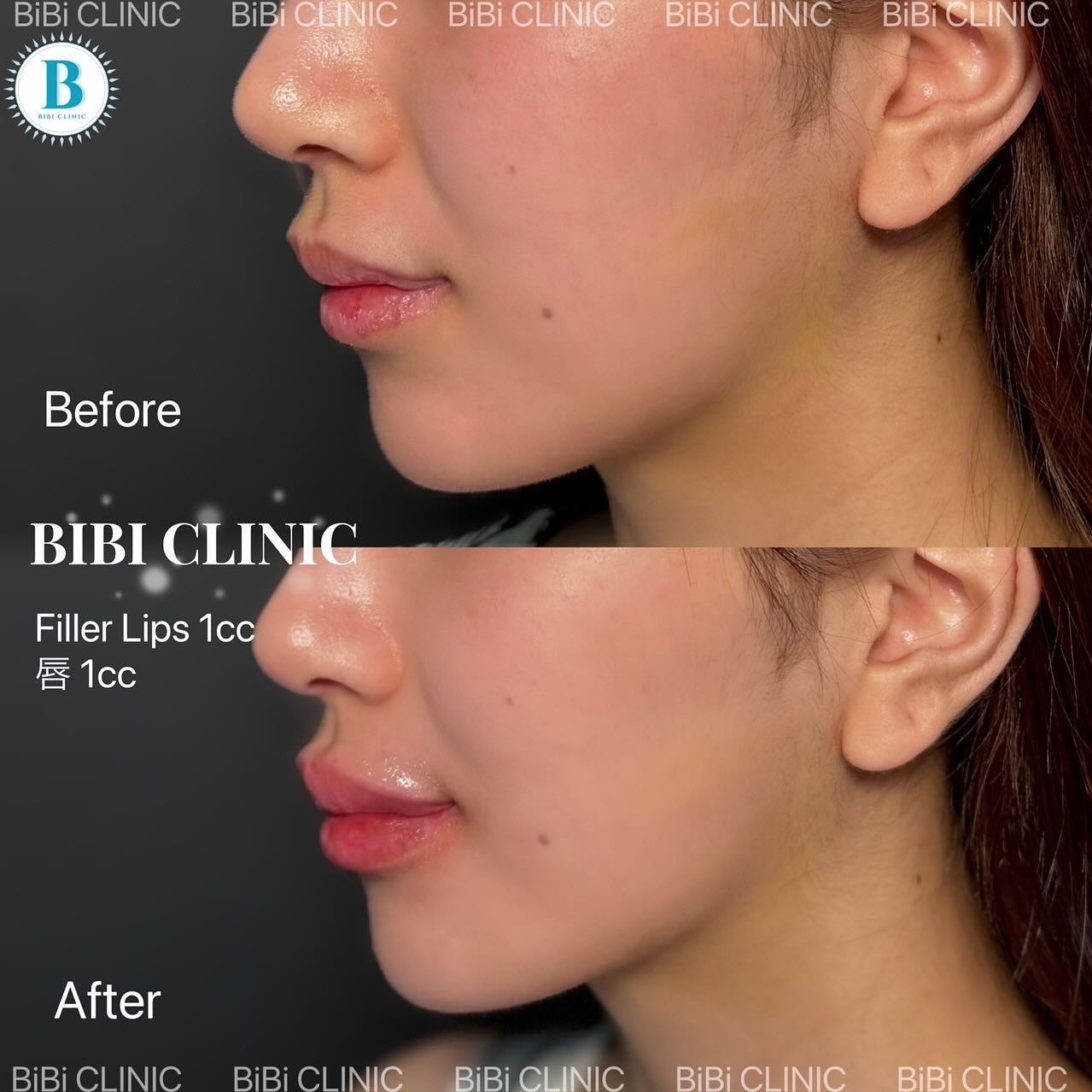Restylane Before-and-After Photos at Bibi Clinic,bangkok