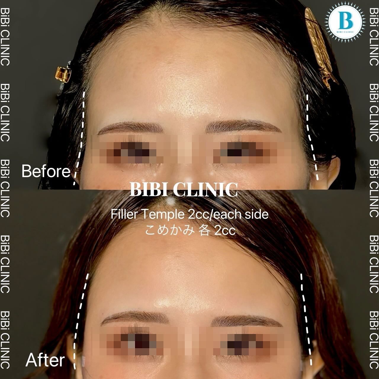 Restylane Before-and-After Photos at Bibi Clinic,bangkok