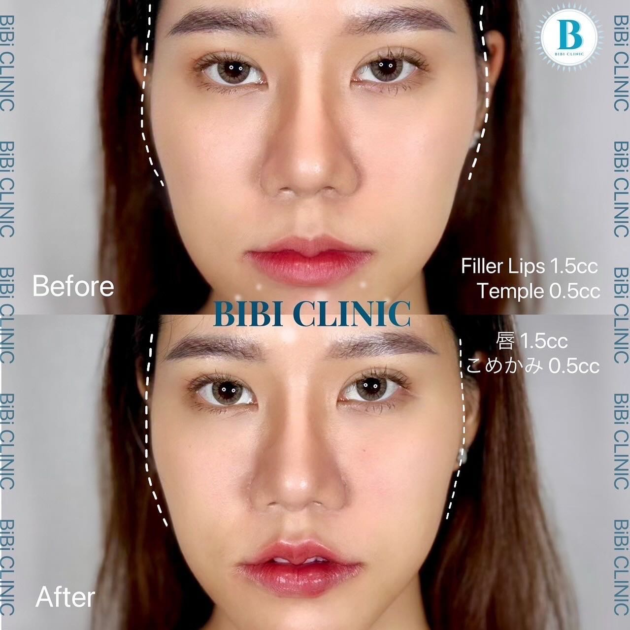 Restylane Before-and-After Photos at Bibi Clinic,bangkok