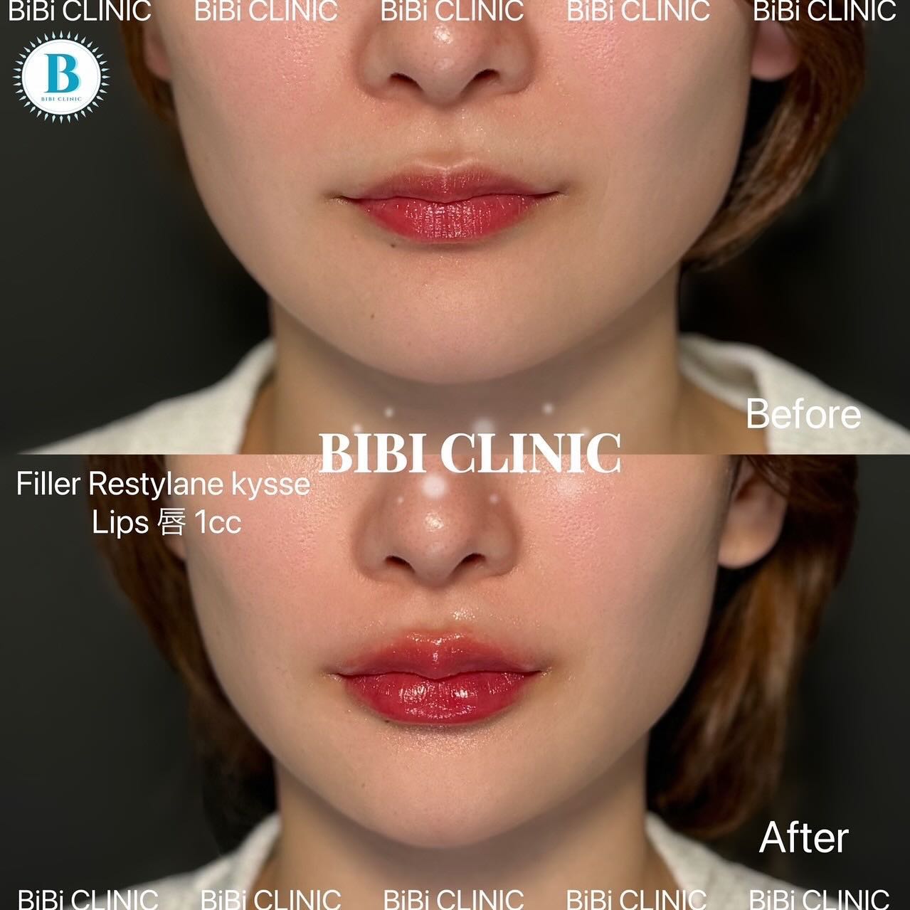 Restylane Before-and-After Photos at Bibi Clinic,bangkok