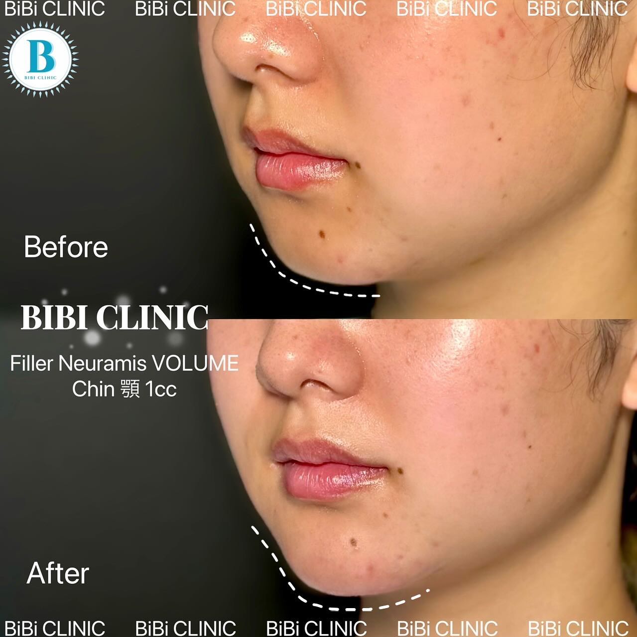 Chin Filler Before-and-After Photos at Bibi Clinic,bangkok