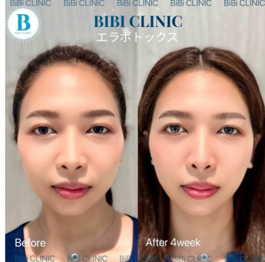 Before and After Photos of Masseter Botox at Bibi Clinic