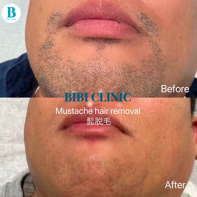 Bibiクリニックでのひげ脱毛のbefore・after