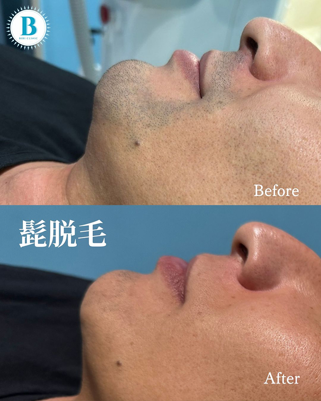 Bibiクリニックでのひげ脱毛のbefore・after