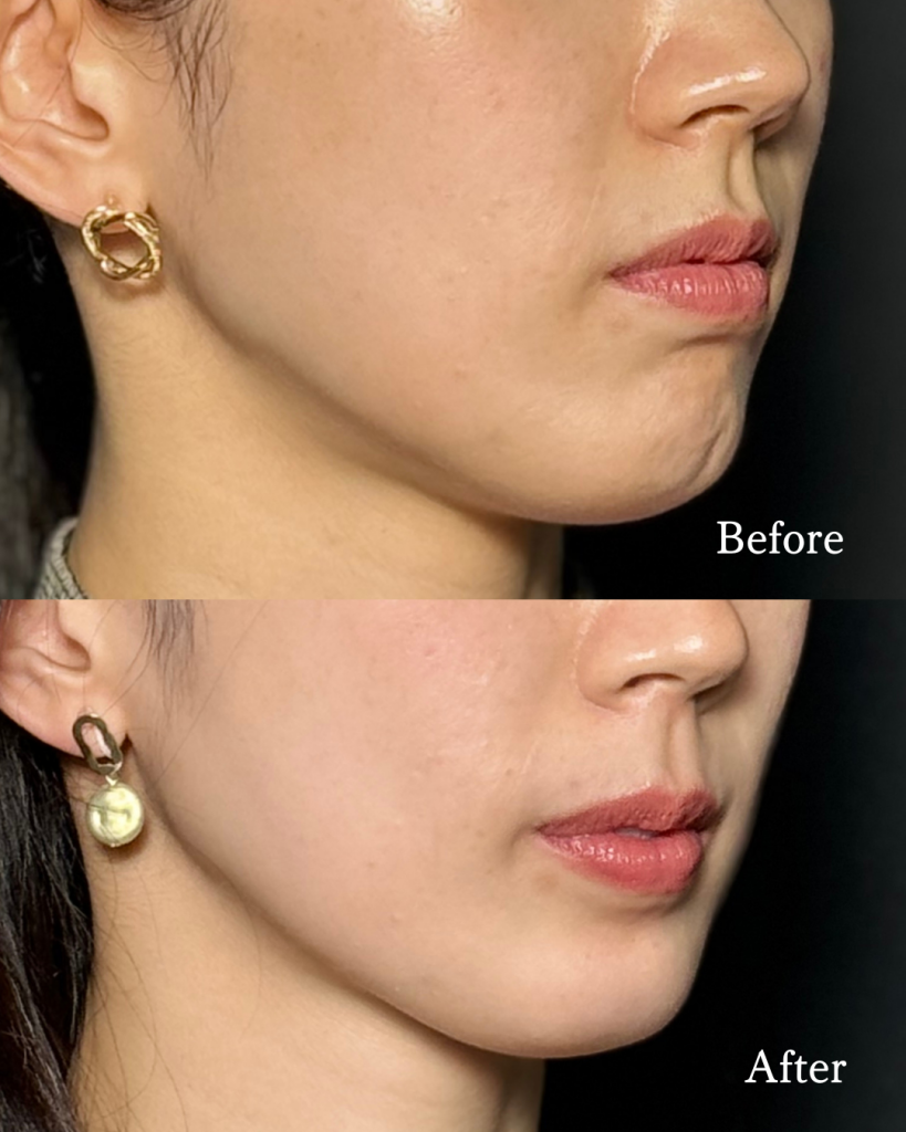 Botulinum toxin Injection
