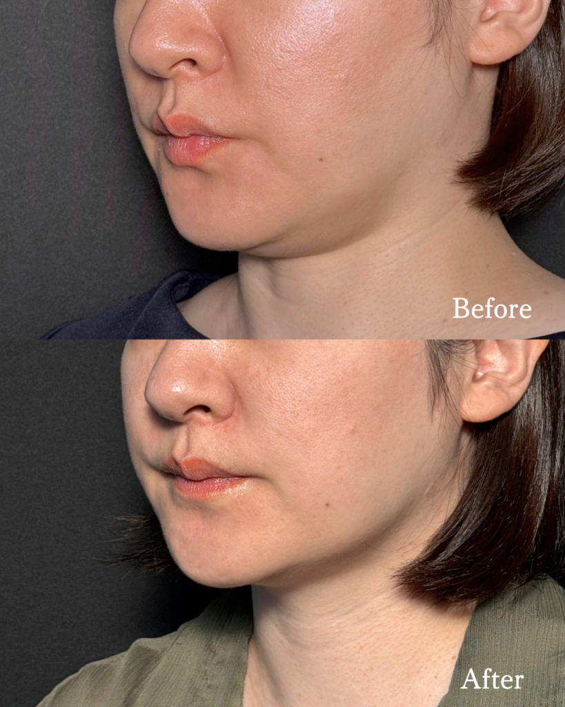 Fat dissolving injections 3 times