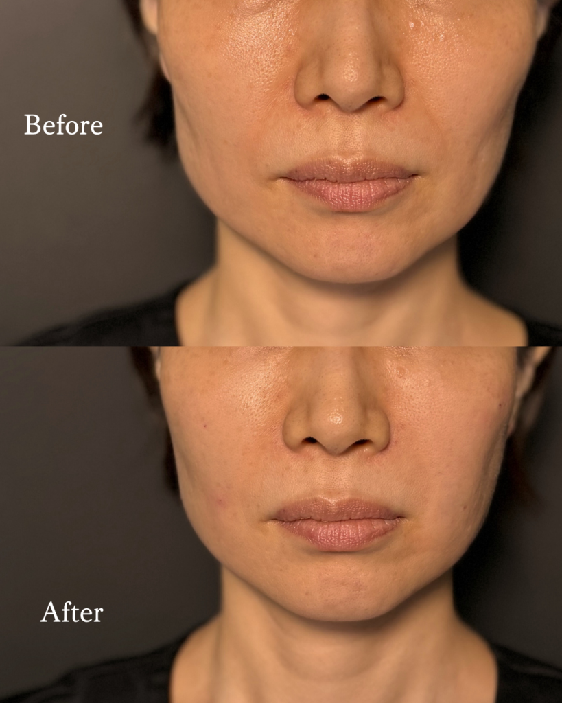 Hyaluronic acid injection　Filler Treatment