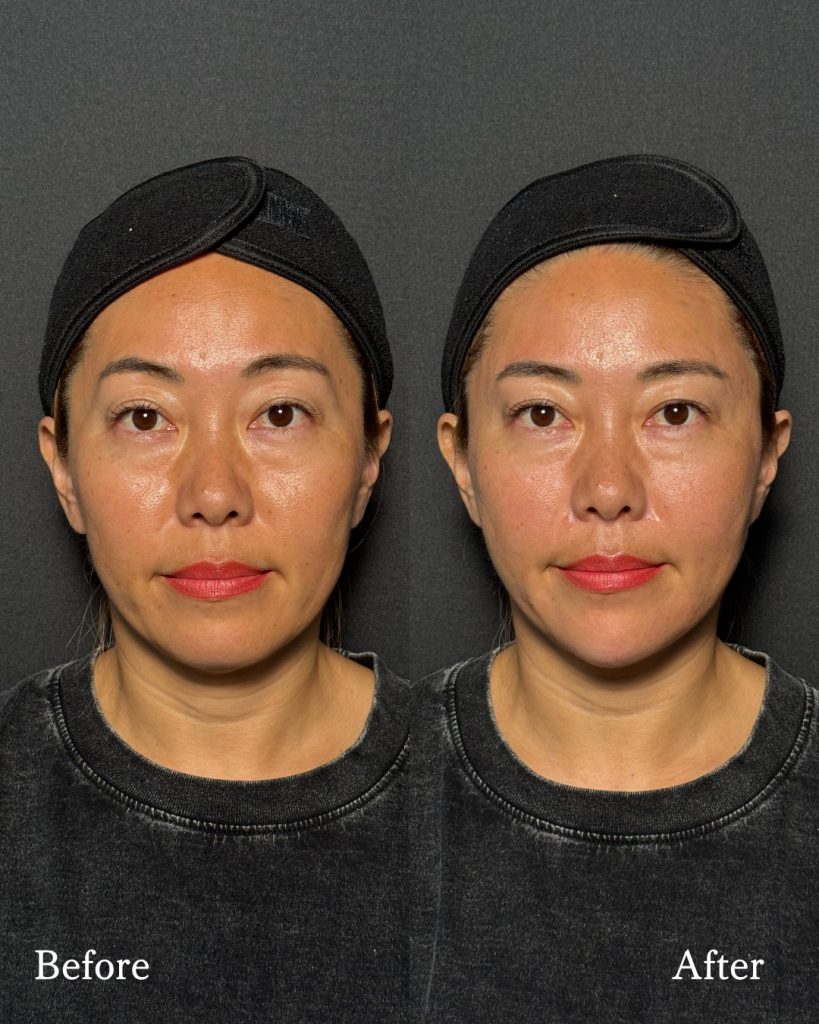 Hyaluronic acid injection　Filler Treatment