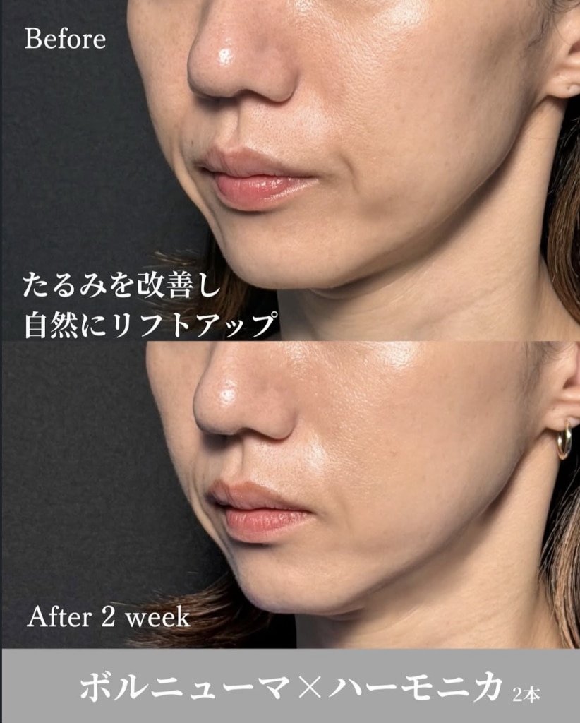 ボルニューマ 400ショット