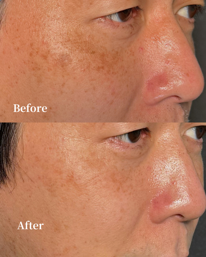 Pico Laser/ Spot mode