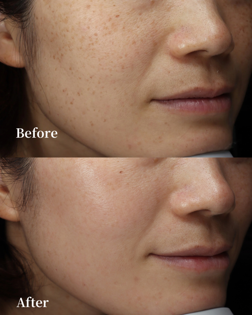 Pico Laser/ Toning, Spot mode + Melasma Injection