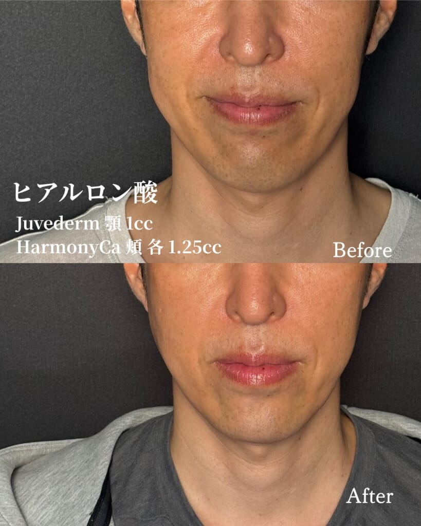 ヒアルロン酸注射 （Juvederm 顎 1cc, HArmonyCa 頬 各1.25cc）