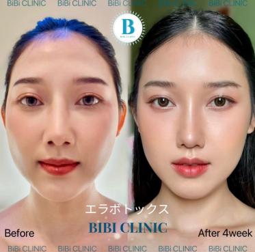 Before and After Photos of Masseter Botox at Bibi Clinic
