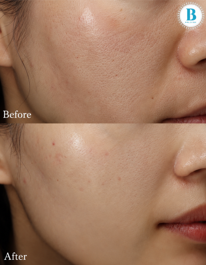 Sylfirm X before and after: the cheek before treatment above, and after 3 sessions below, photographed at the same angle and lighting