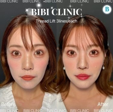 Thread lift before and after results