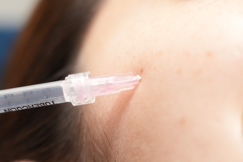 Skin injection procedure
